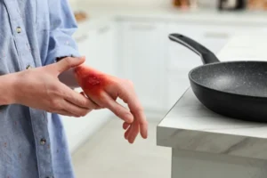 Atlanta burn injury lawyer