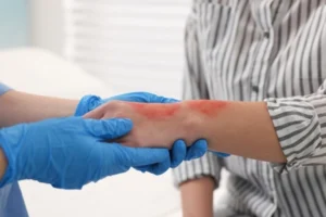 burn injury